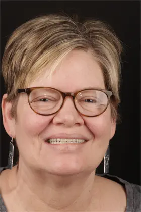 Brightened smile of a patient following professional gum depigmentation treatment.